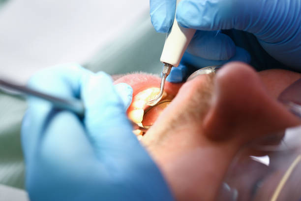 Best Emergency Tooth Extraction in Pella, IA