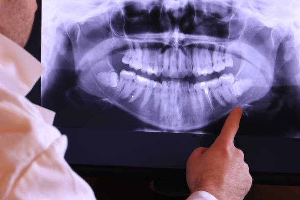 Best Emergency Wisdom Teeth Removal in Pella, IA
