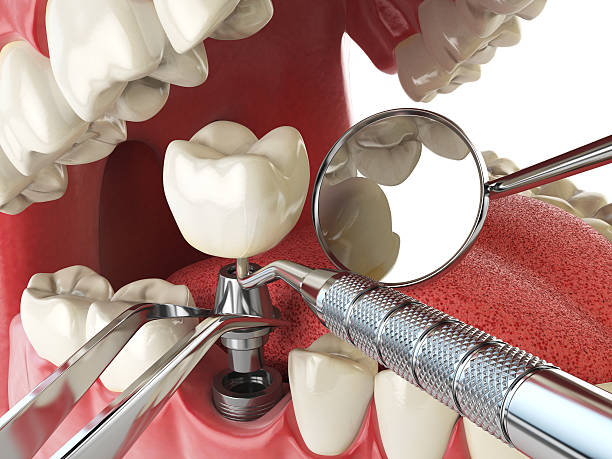 Best Emergency Tooth Extraction in Pella, IA